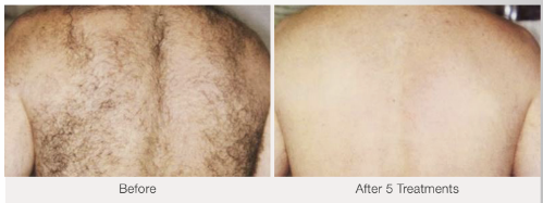 laser hair removal back before and after